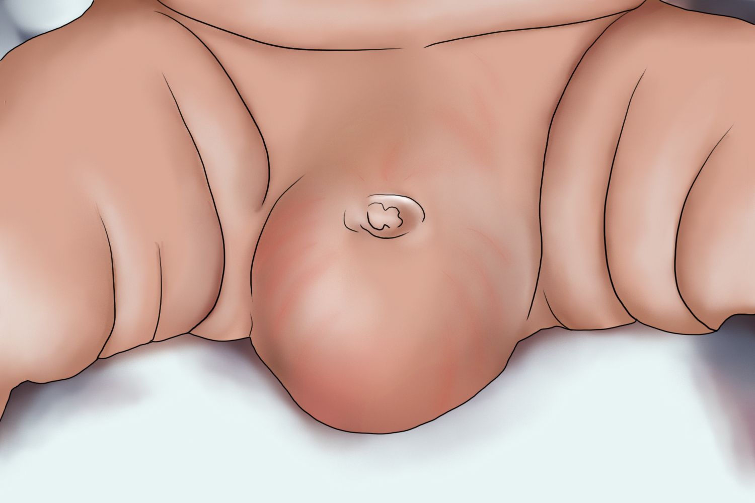 睾丸鞘膜积液图