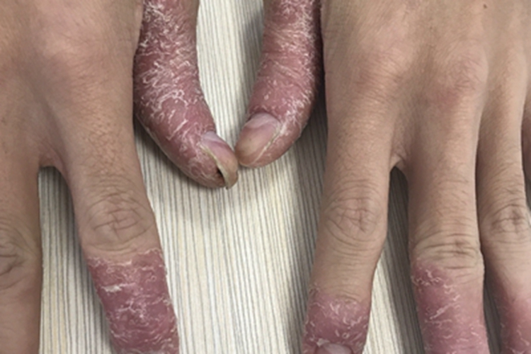 连续性肢端皮炎手指脱屑图