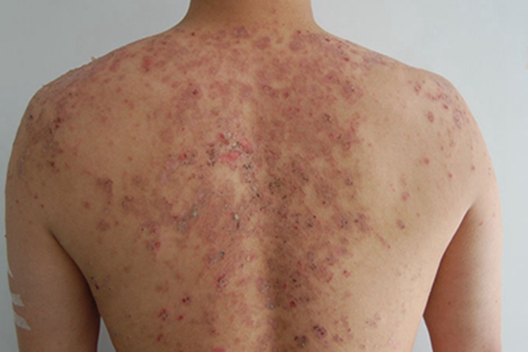 亚急性湿疹背部症状图