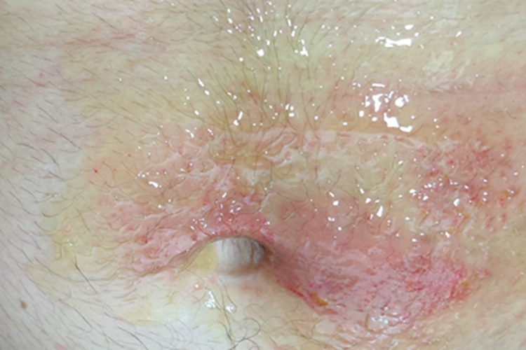 急性接触性皮炎腹部渗液图 急性接触性皮炎腹部渗液图