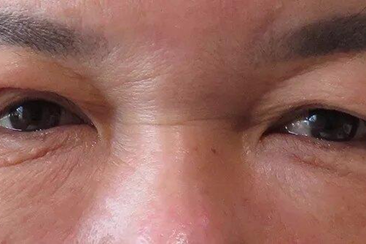 严重泪腺脱垂图