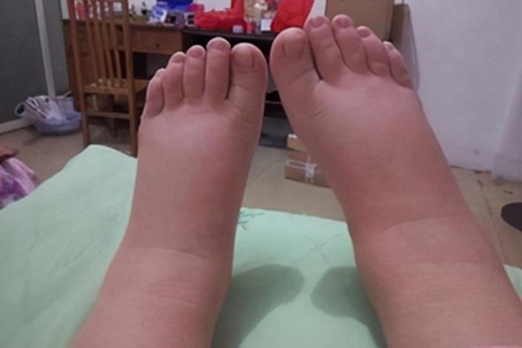 获得性血管性水肿脚背水肿图