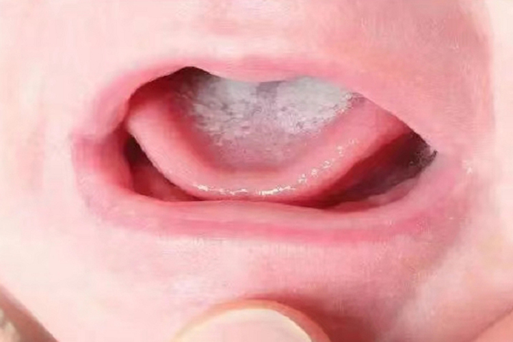 孩子舌头鹅口疮白色斑块图 孩子舌头鹅口疮白色斑块图