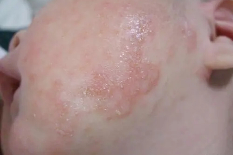 新生儿亚急性湿疹图