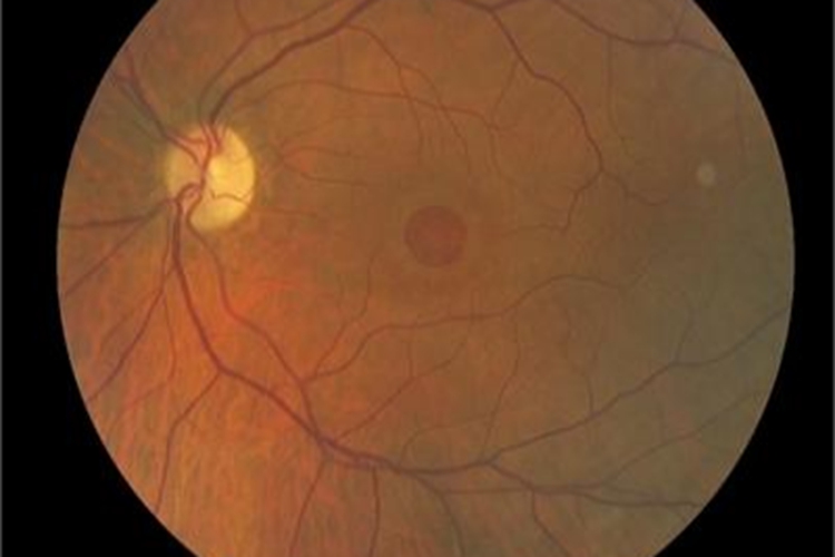 黄斑裂孔图