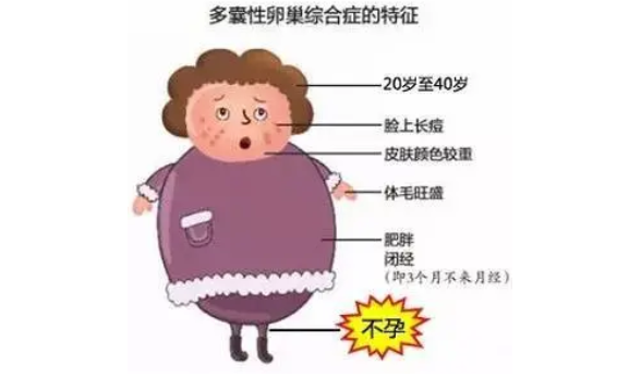 多囊卵巢综合症.png
