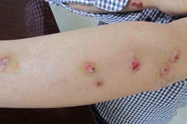 职业性痒疹糜烂图