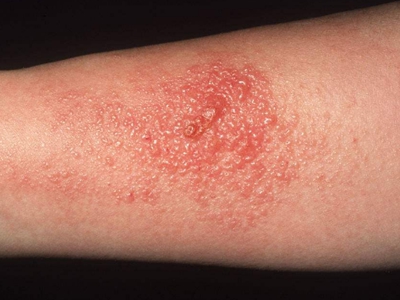 急性接触性皮炎胳膊上长了很多小水疱图