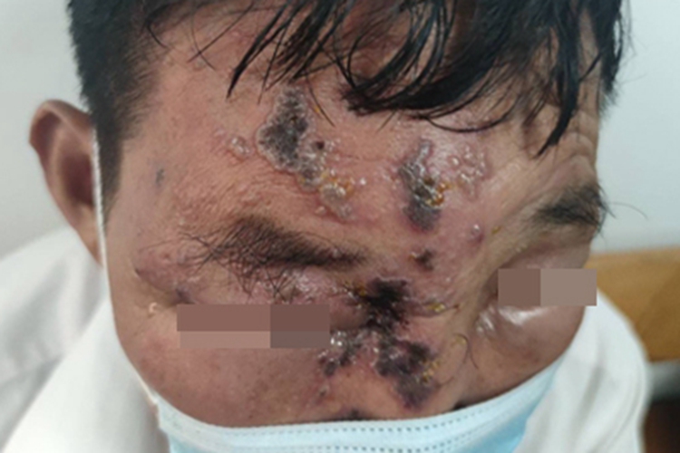 带状疱疹面部黑痂图