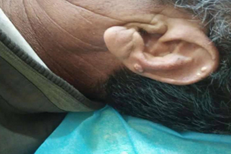 痛风左耳外侧耳廓上长结节图