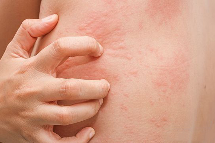 慢性自发性荨麻疹图