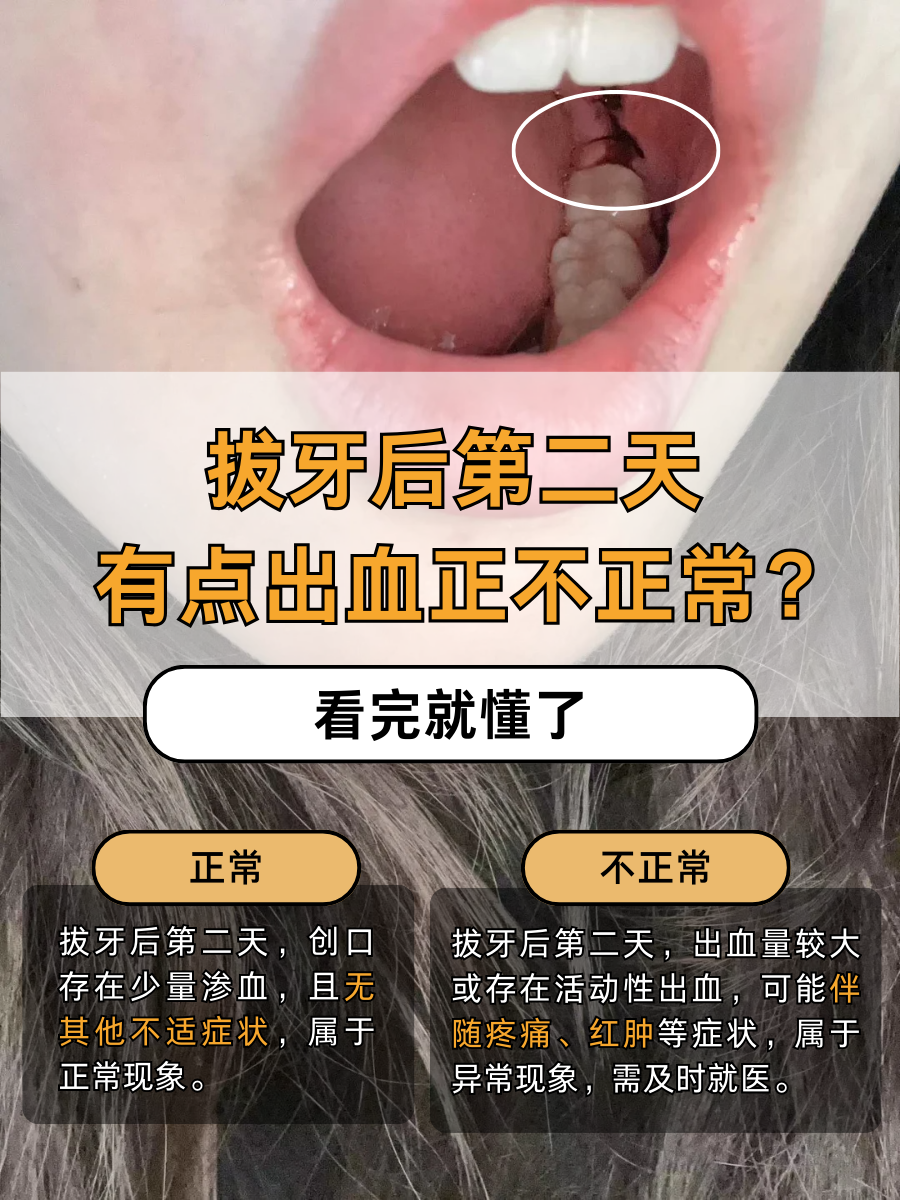 拔牙后第二天有点出血正不正常？看完就懂了