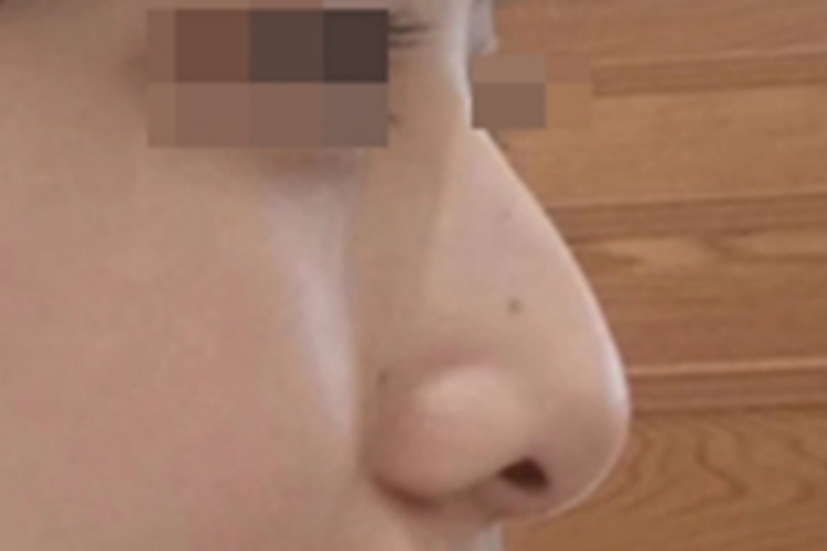 鹰钩鼻鼻尖过长且向下图