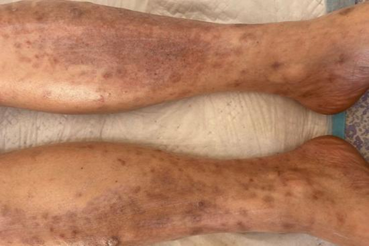 男生慢性湿疹图