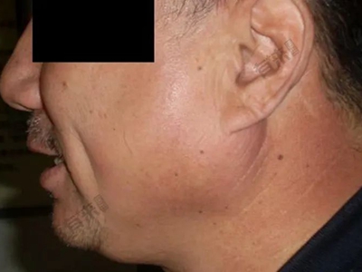 流行性腮腺炎左侧面部肿胀图.jpeg