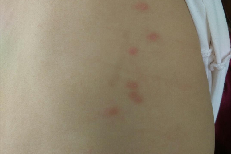 虫咬皮炎背部小红疙瘩图