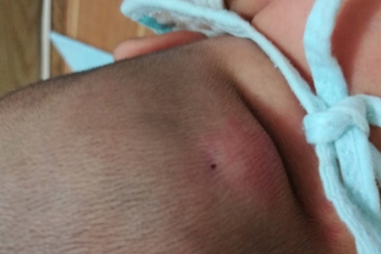 后脑右侧皮脂腺囊肿图 后脑右侧皮脂腺囊肿图