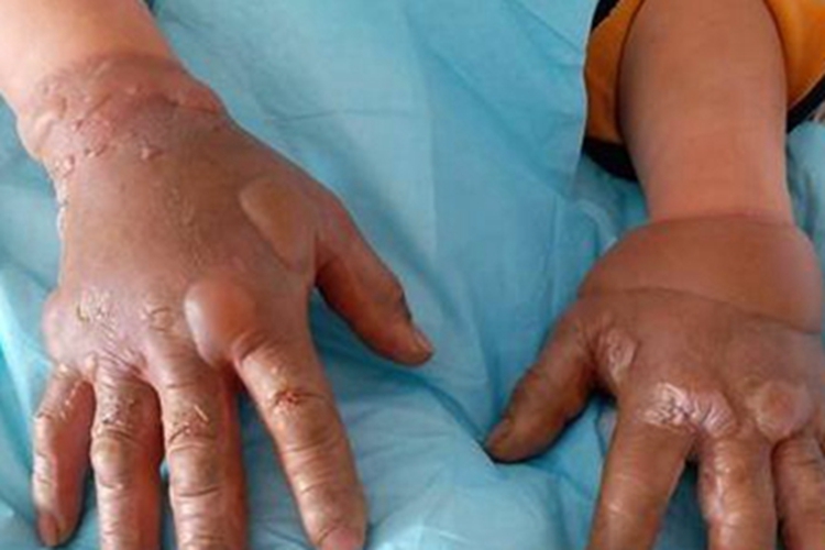 深Ⅱ度烧伤手部大水疱图