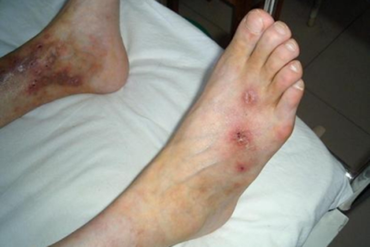 迟发性皮肤卟啉病症状图 迟发性皮肤卟啉病症状图