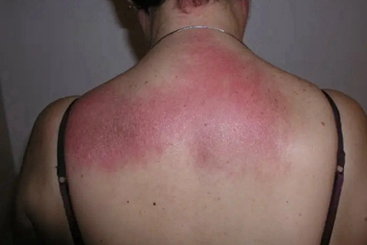 硬红斑后背结节斑块图