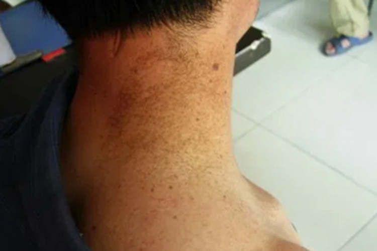 日光性雀斑样痣颈部斑图