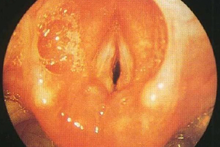 急性喉炎症状图