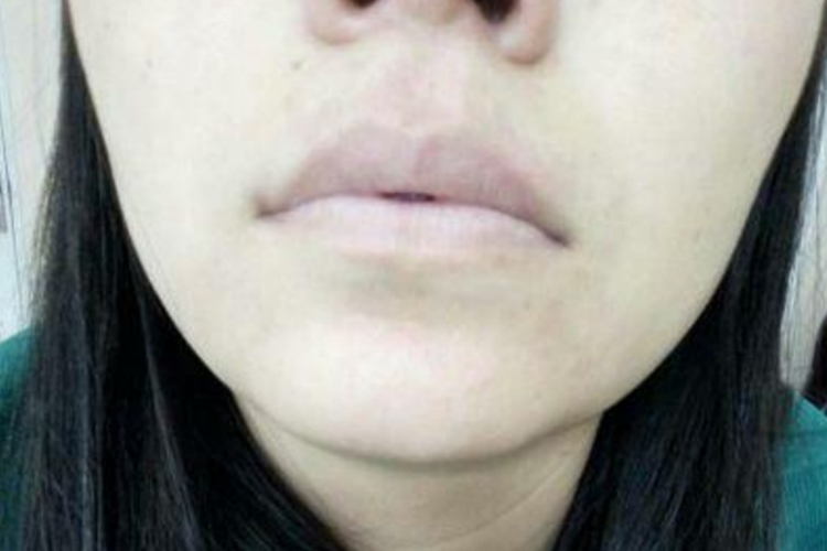 贫血面色苍白图