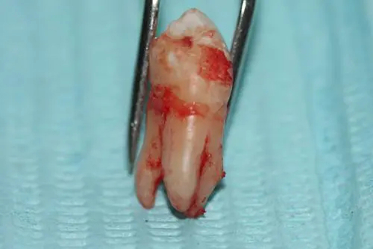 上颌磨牙3个牙根图