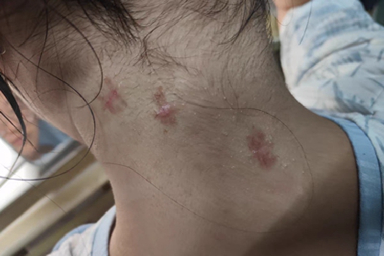 瘢痕疙瘩后颈部有红色疙瘩图 瘢痕疙瘩后颈部有红色疙瘩图