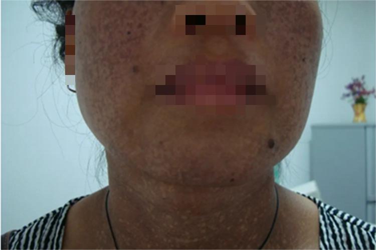 皮肤黑变病面部皮肤发黑图 皮肤黑变病面部皮肤发黑图