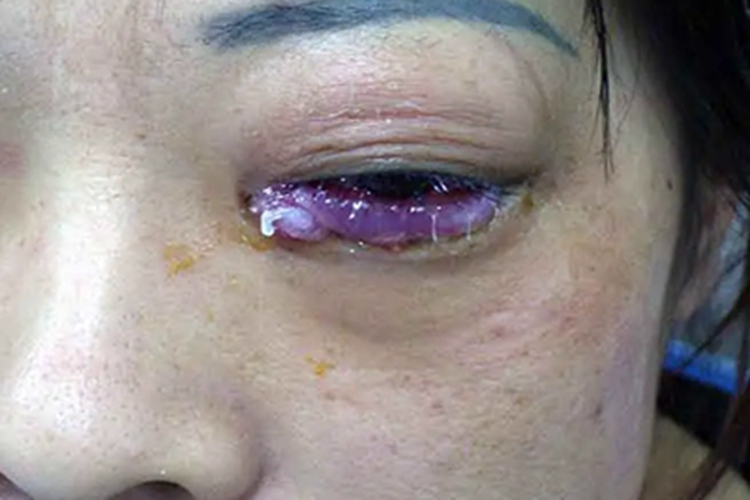 眼眶蜂窝织炎眼部水肿图 眼眶蜂窝织炎眼部水肿图