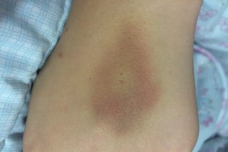 穿刺点皮下淤血红斑图