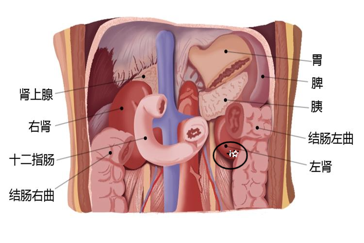 左肾下盏结石位置图