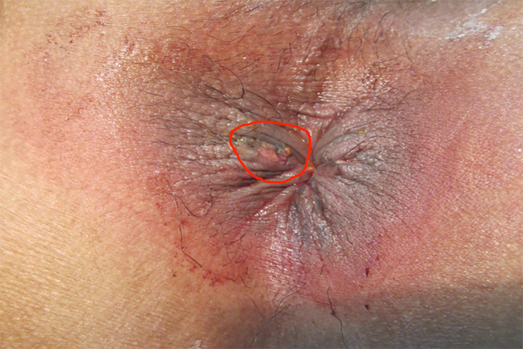 痔疮手术25天肉芽图