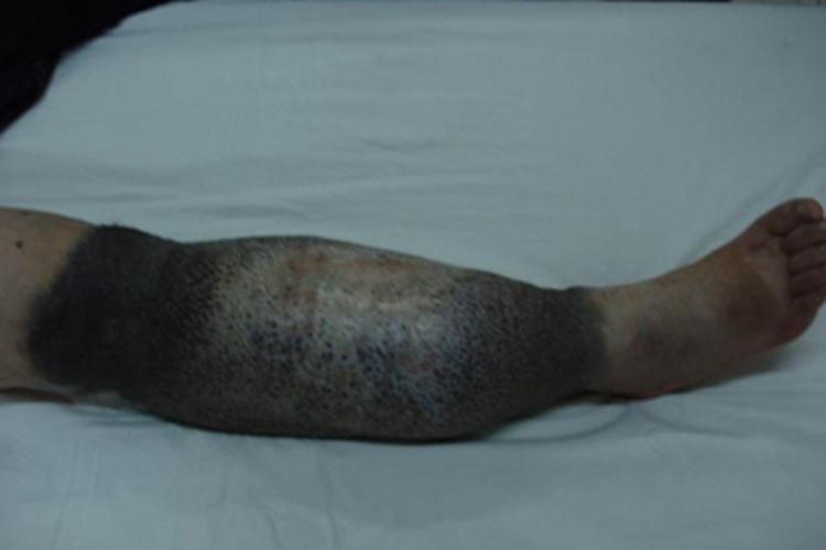 淋巴水肿小腿皮肤发黑图 淋巴水肿小腿皮肤发黑图