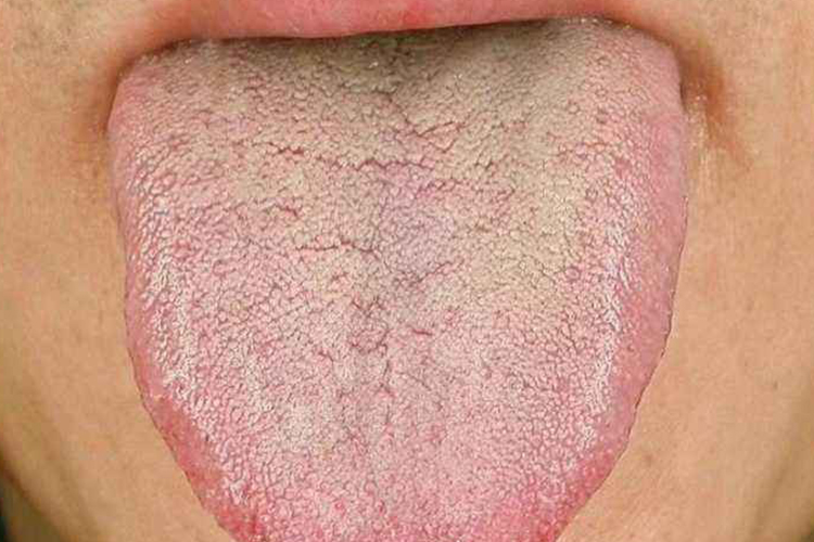 阴虚湿热舌苔图