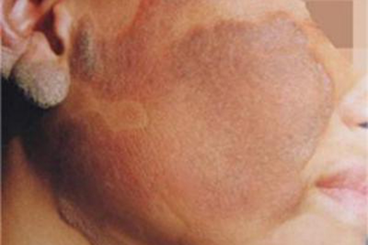 可变性红斑角化症有斑图