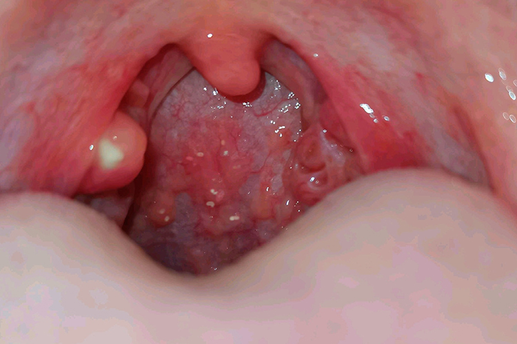 急性咽炎位置图 急性咽炎位置图