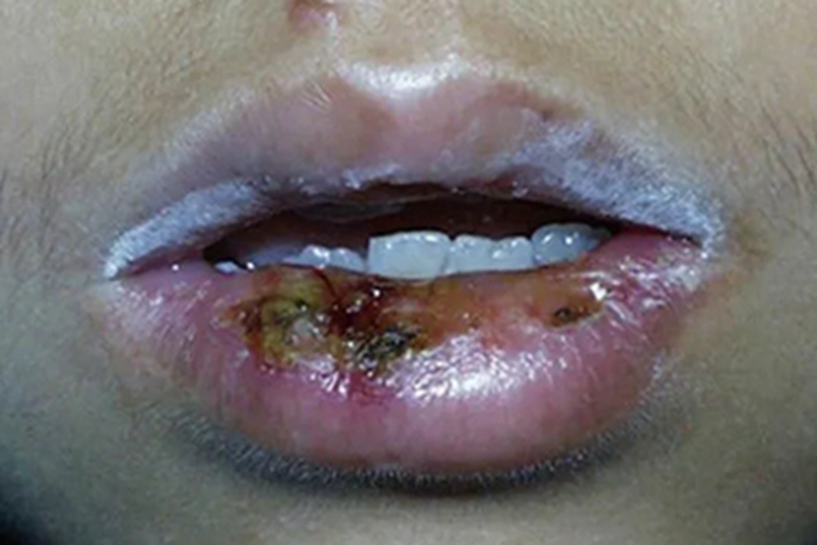 药物过敏性口炎嘴唇化脓图 药物过敏性口炎嘴唇化脓图