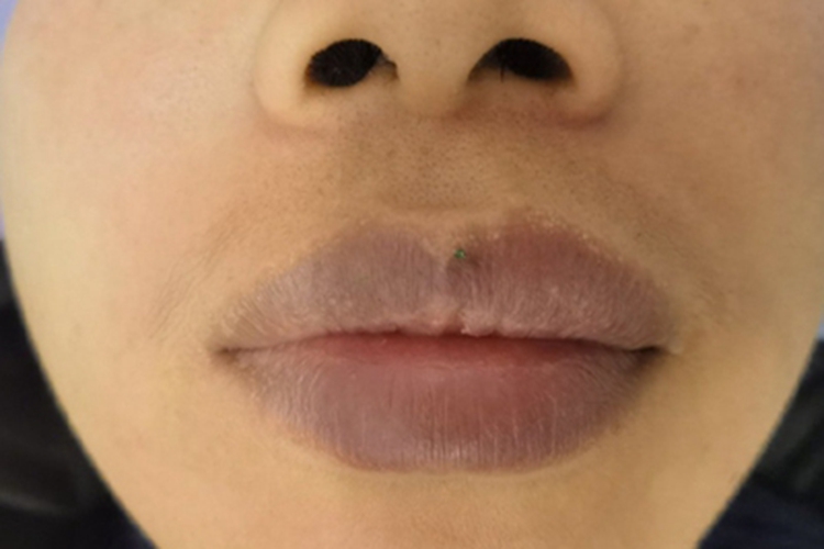 皮脂腺异位症上嘴唇上长小白点图 皮脂腺异位症上嘴唇上长小白点图
