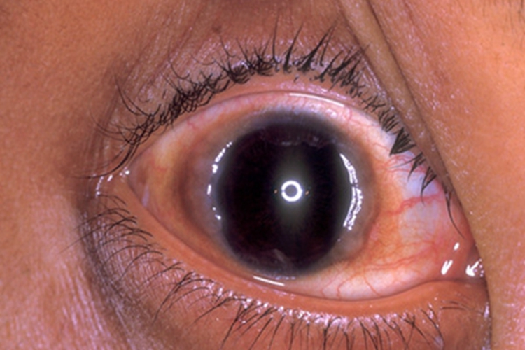 特应性角结膜炎症状图 特应性角结膜炎症状图