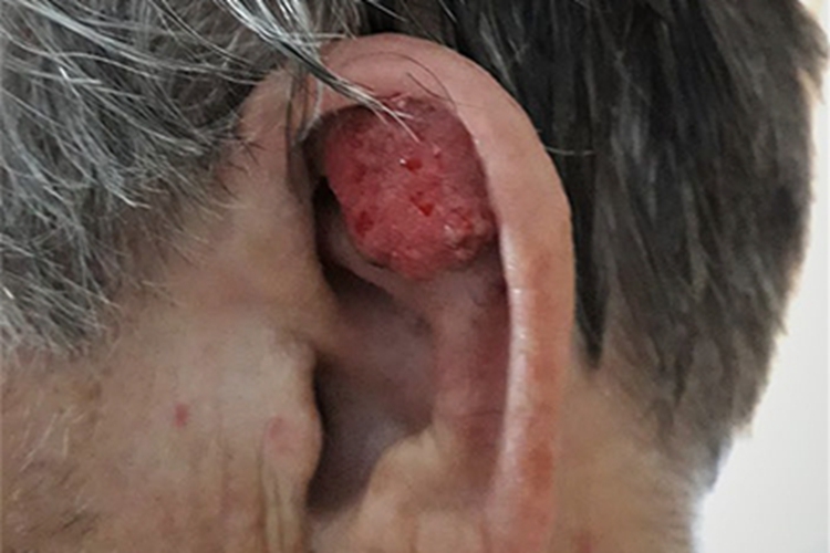 皮肤鳞状细胞癌耳部瘤图