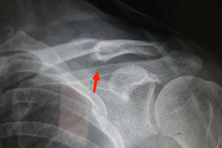 锁骨骨折畸形愈合影像图