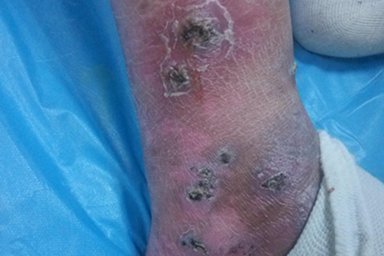 结节性血管炎脚踝症状图 结节性血管炎脚踝症状图