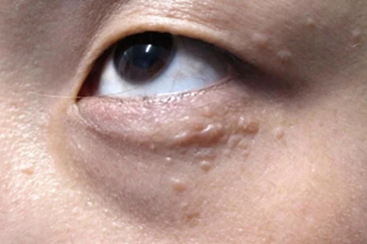 汗管瘤眼周丘疹图