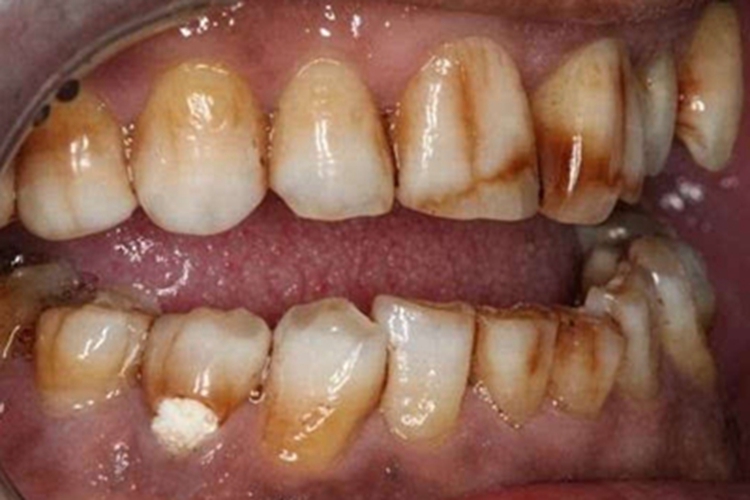 氟牙症牙齿有条纹样改变图