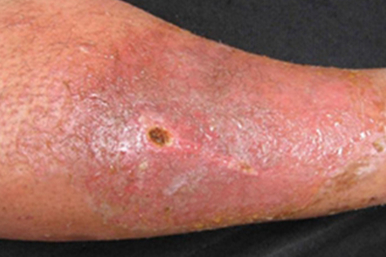 亚急性湿疹小水疱图