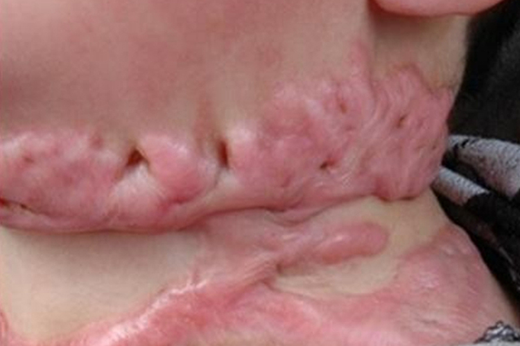 三度烧伤鲜红色疤痕图