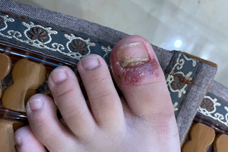 近端甲下型甲真菌病脚趾甲症状图 近端甲下型甲真菌病脚趾甲症状图