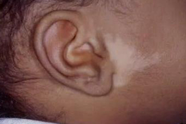 脱色素性痣耳前症状图